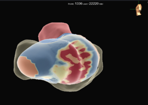 Case of VT procedure using ADAS3D with Ensite and HD-grid - Adas 3D